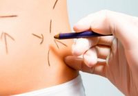Tratamiento de varices con microespuma